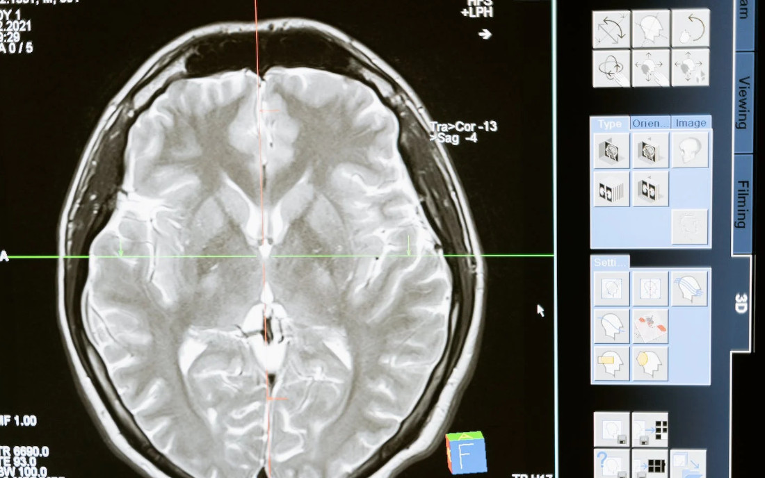 Badanie mózgu podczas stosowania marihuany